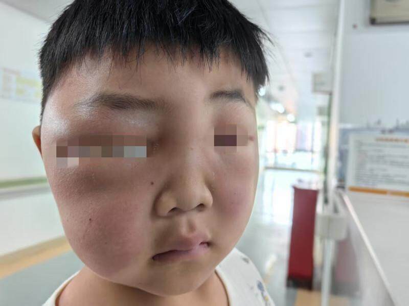 高发季到来！4岁男孩睡梦中被叮一口肿成“发面馒头”